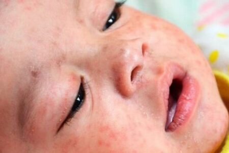 برای جلوگیری از سرخک واکسیناسیون کودکان را تکمیل کنید