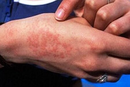 ابتلای ۱۳۳ نفر از رفسنجانی‌ها به تب مالت در سال گذشته