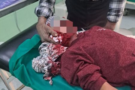 مصدومیت پسر بچه ۱۴ ساله راوری بر اثر انفجار مواد محترقه