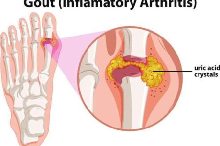 نقرس؛ درد مفاصل ناشی از اسید اوریک