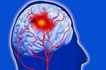 بیماری‌های زمینه‌ای در ابتلا به سکته مغزی مؤثر هستند | خبر کرمان