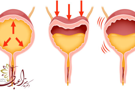 علت و درمان بی اختیاری ادرار